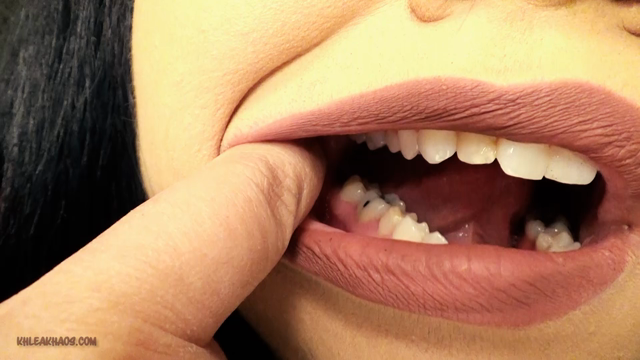 Post Molar Removal Mouth Tour video from 