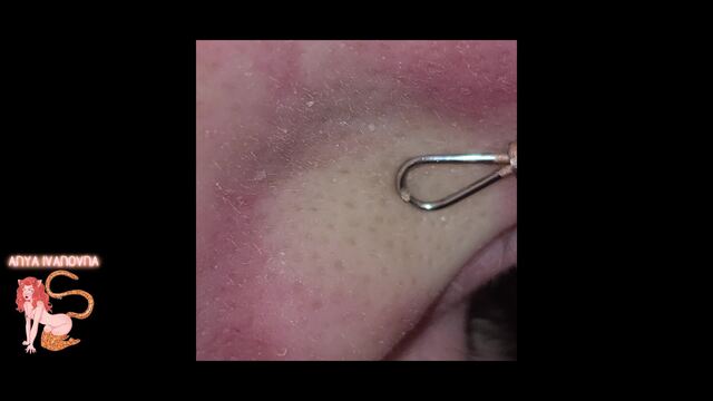 Amateur Pimple Popper: Episode Two - Digging In video from Anya Ivanovna
