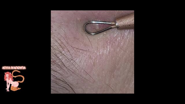 Amateur Pimple Popper Episode One  Juicy Zits video from Anya Ivanovna