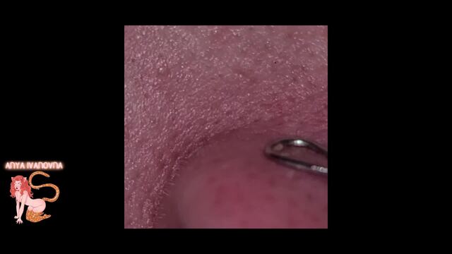 Amateur Extractions video from Anya Ivanovna