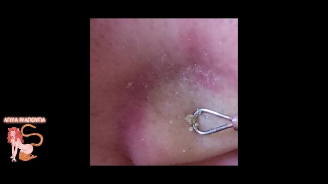 Amateur Pimple Popper: Episode Three - Large Blackhead Extraction video from Anya Ivanovna