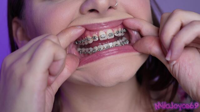 Braces Mouth Tour video from Milajoyce69