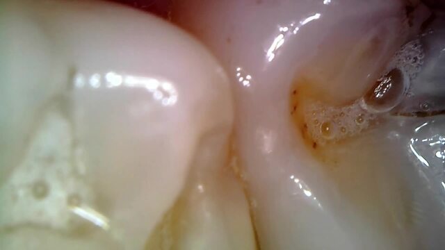 Medical Endoscope Oral Exam: Gummy Chewing, Extreme Teeth & Tongue Macro video from NicoleFetish